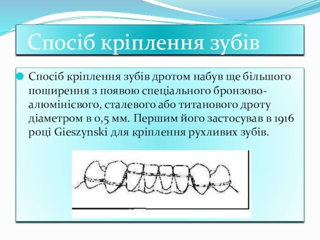 Спосiб крiплення зубiвСпосіб кріплення зубів дротом набув ще більшого поширення з появою спеціального бронзово-алюмінієвого,