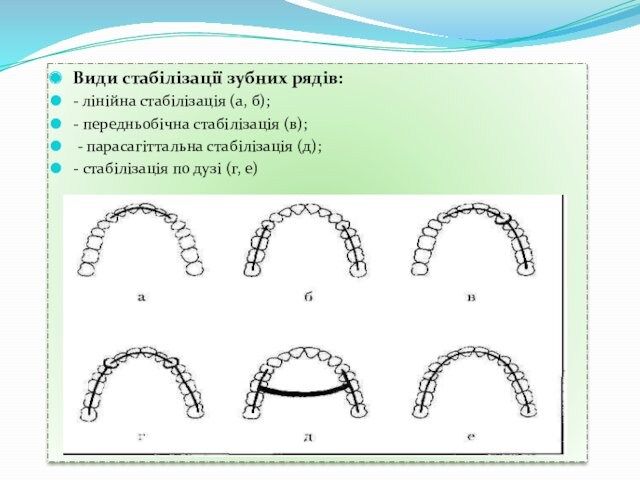 Види стабілізації зубних рядів: - лінійна стабілізація (а, б); - передньобічна стабілізація (в); - парасагіттальна