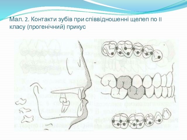 Мал. 2. Контакти зубів при співвідношенні щелеп по II класу (прогенічний) прикус