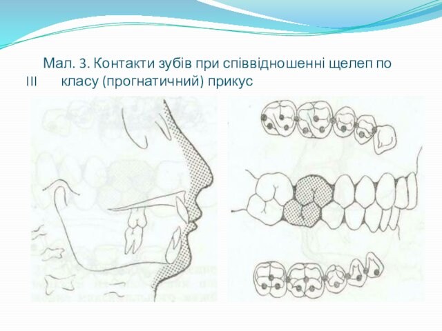 Мал. 3. Контакти зубів при співвідношенні щелеп по III  класу (прогнатичний) прикус
