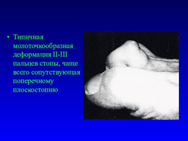 Типичная молоточкообразная деформация II-III пальцев стопы, чаще всего сопутствующая поперечному плоскостопию