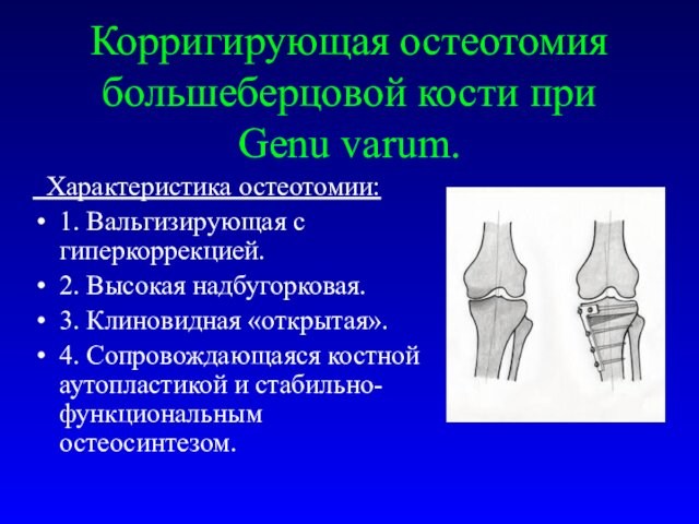 Корригирующая остеотомия большеберцовой кости при Genu varum. Характеристика остеотомии:1. Вальгизирующая с гиперкоррекцией.2. Высокая надбугорковая.3. Клиновидная
