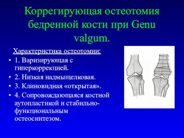 Коррегирующая остеотомия бедренной кости при Genu valgum.  Характеристика остеотомии:1. Варизирующая с гиперкоррекцией.2. Низкая надмыщелковая.3.