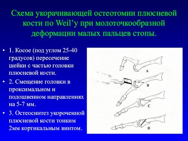 Схема укорачивающей остеотомии плюсневой кости по Weil’у при молоточкообразной деформации малых пальцев стопы.1. Косое (под