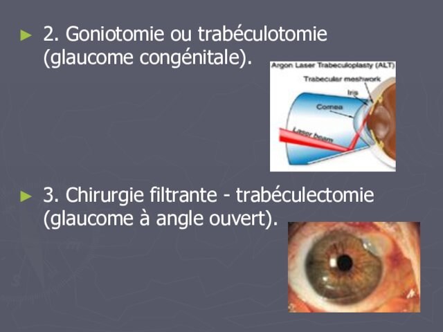2. Goniotomie ou trabéculotomie (glaucome congénitale). 3. Chirurgie filtrante - trabéculectomie (glaucome à angle ouvert).