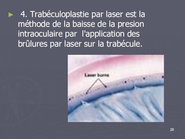 4. Trabéculoplastie par laser est la méthode de la baisse de la presion intraoculaire