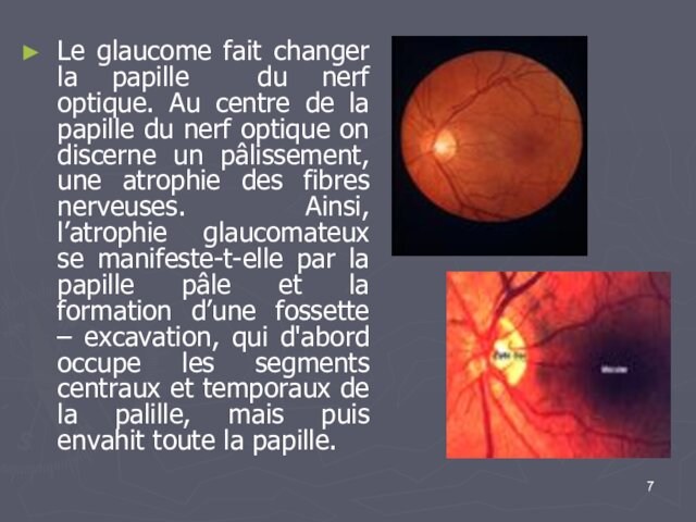 Le glaucome fait changer la papille du nerf optique. Au centre de la papille du