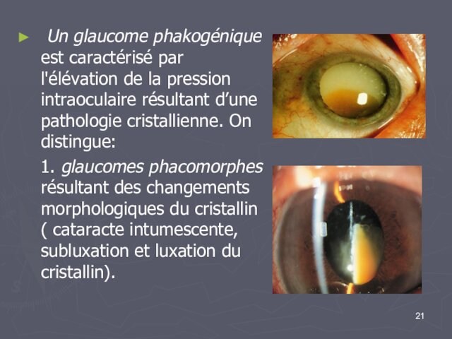 Un glaucome phakogénique est caractérisé par l'élévation de la pression intraoculaire résultant d’une pathologie
