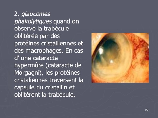 2. glaucomes phakolytiques quand on observe la trabécule oblitérée par des protéines cristalliennes et