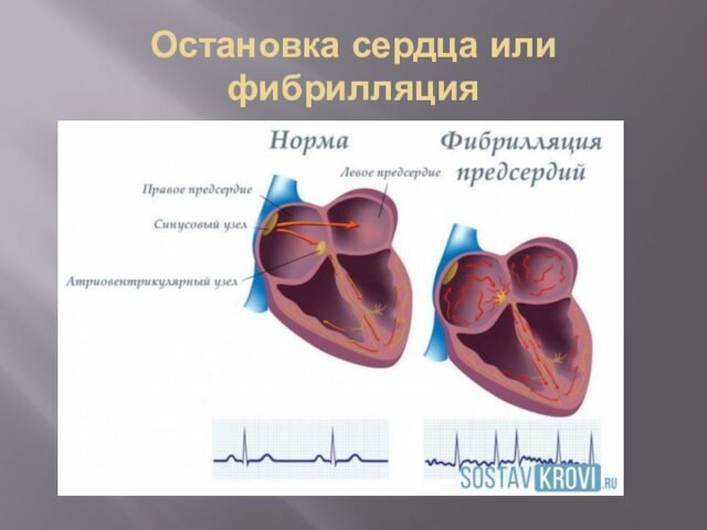 Остановка сердца или фибрилляция
