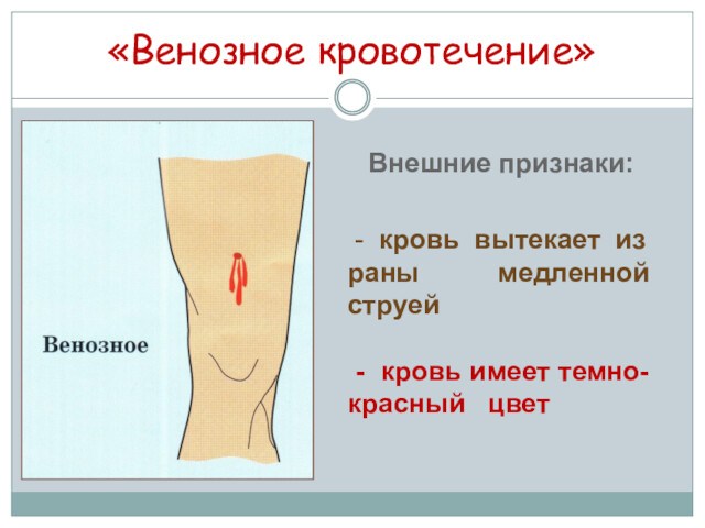 Презентация по обж на тему первая помощь при кровотечениях