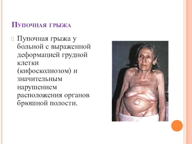 Пупочная грыжаПупочная грыжа у больной с выраженной деформацией грудной клетки (кифосколиозом) и значительным нарушением расположения органов