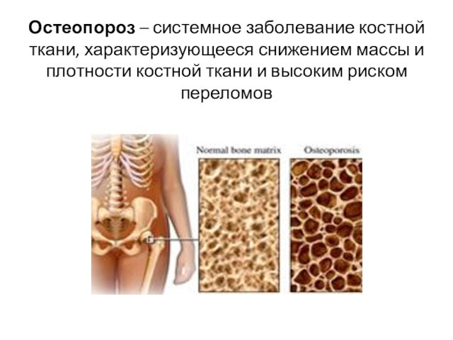 Остеопороз – системное заболевание костной ткани, характеризующееся снижением массы и плотности костной ткани и высоким риском