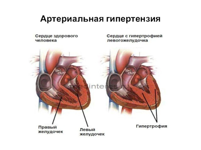 Артериальная гипертензия