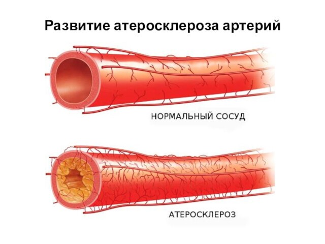 Развитие атеросклероза артерий