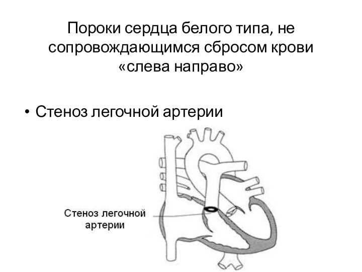 Пороки сердца белого типа, не сопровождающимся сбросом крови «слева направо» Стеноз легочной артерии