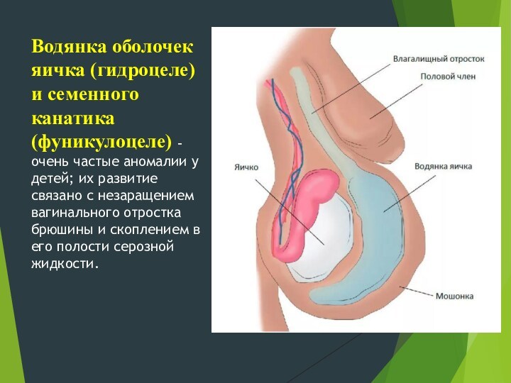 Водянка оболочек яичка (гидроцеле) и семенного канатика (фуникулоцеле) – очень частые аномалии у детей; их