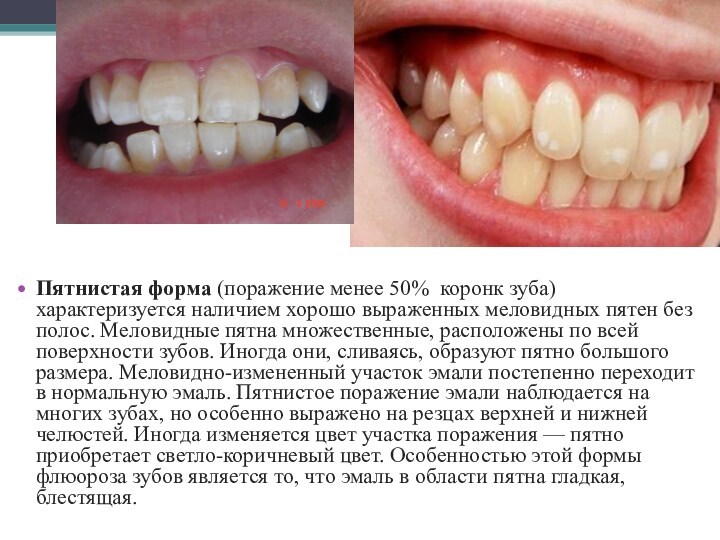 Пятнистая форма (поражение менее 50% коронк зуба) характеризуется наличием хорошо выраженных меловидных пятен без полос.