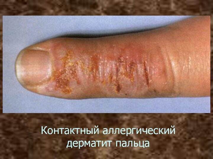Контактный аллергический дерматит пальца