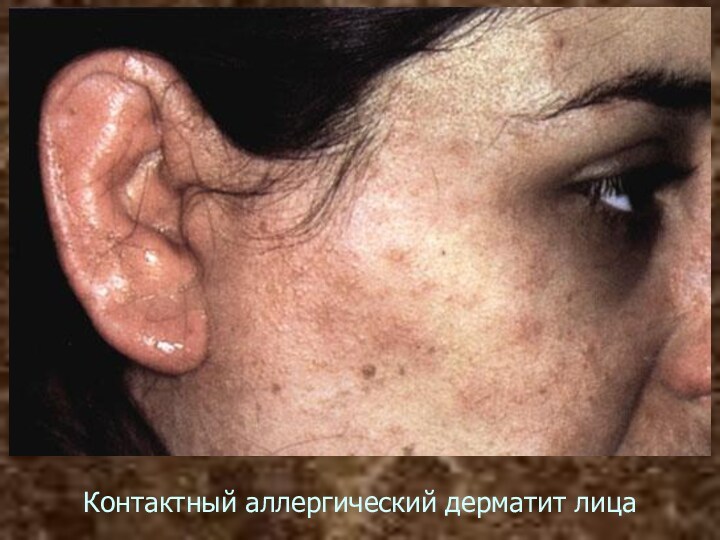 Контактный аллергический дерматит лица