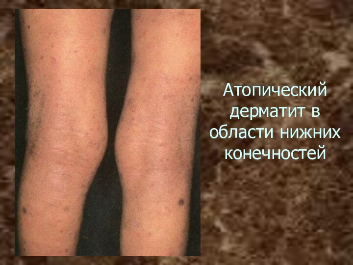 Атопический дерматит в области нижних конечностей