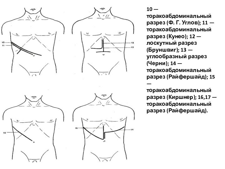 10 — торакоабдоминальный разрез (Ф. Г. Углов); 11 — торакоабдоминальный разрез (Кунео); 12 — лоскутный