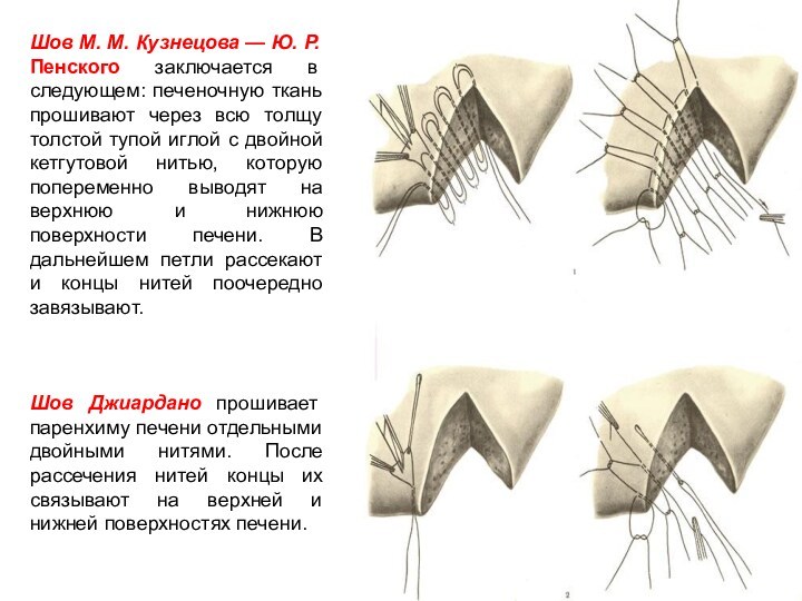 Шов М. М. Кузнецова — Ю. Р. Пенского заключается в следующем: печеночную ткань прошивают через