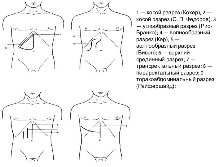 1 — косой разрез (Кохер); 2 — косой разрез (С. П. Федоров); 3 — углообразный