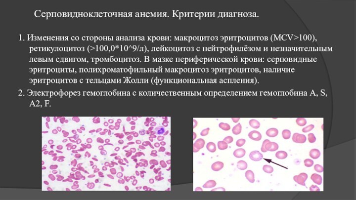 Серповидноклеточная анемия. Критерии диагноза. 1. Изменения со стороны анализа крови: макроцитоз эритроцитов (MCV>100), ретикулоцитоз (>100,0*10^9/л),