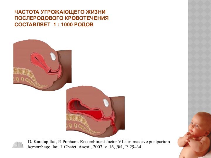 D. Karalapillai, P. Popham. Recombinant factor VIIa in massive postpartum hemorrhage. Int. J. Obstet. Anest.,