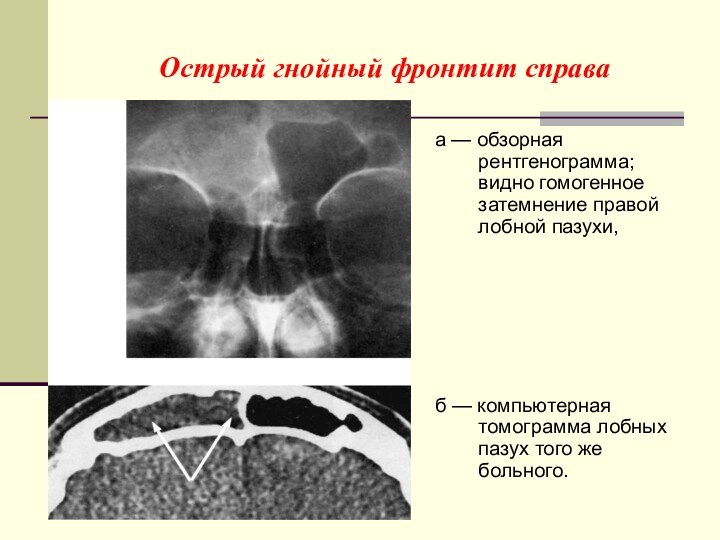 Острый гнойный фронтит справаа — обзорная  рентгенограмма;  видно гомогенное  затемнение правой