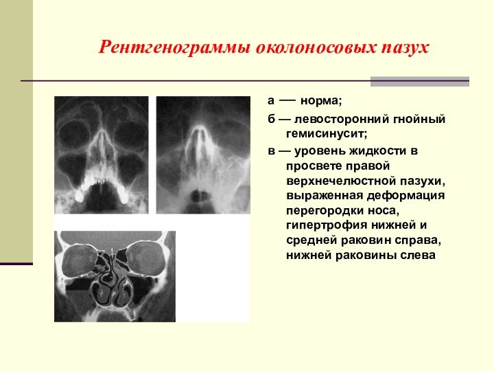 Рентгенограммы околоносовых пазух а — норма; б — левосторонний гнойный гемисинусит;  в — уровень