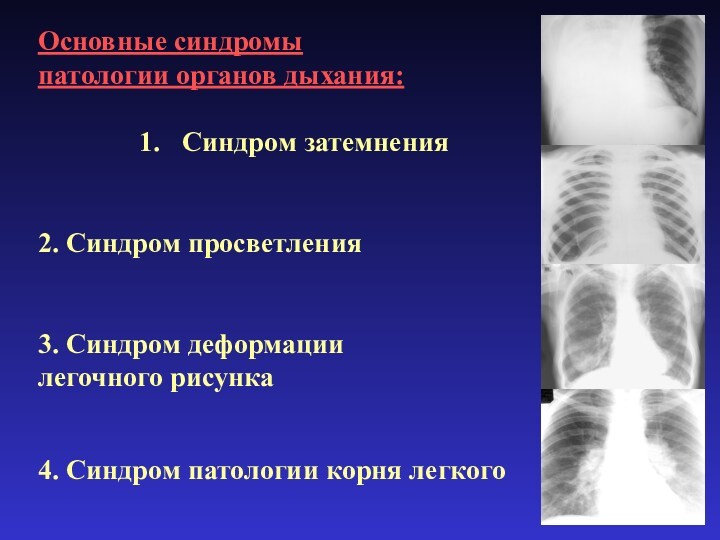 Основные синдромы патологии органов дыхания:Синдром затемнения2. Синдром просветления3. Синдром деформациилегочного рисунка4. Синдром патологии	корня легкого