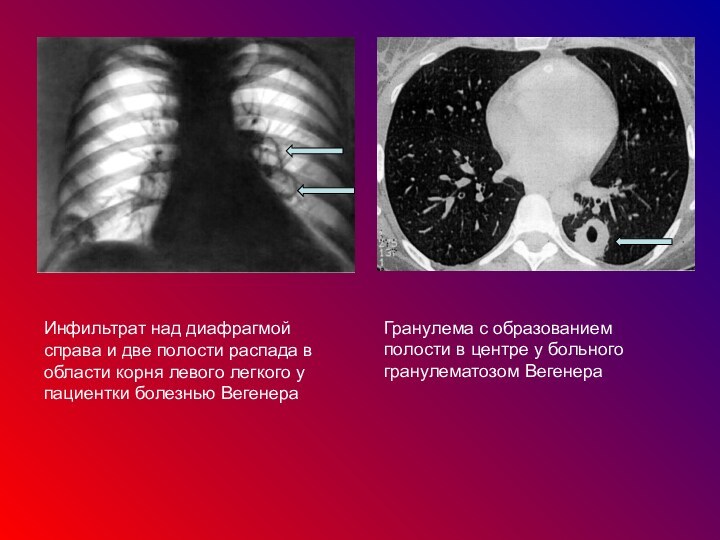 Инфильтрат над диафрагмой справа и две полости распада в области корня левого легкого у пациентки