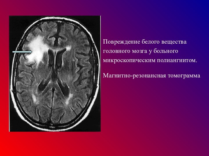 Повреждение белого вещества головного мозга у больного микроскопическим полиангиитом.  Магнитно-резонансная томограмма
