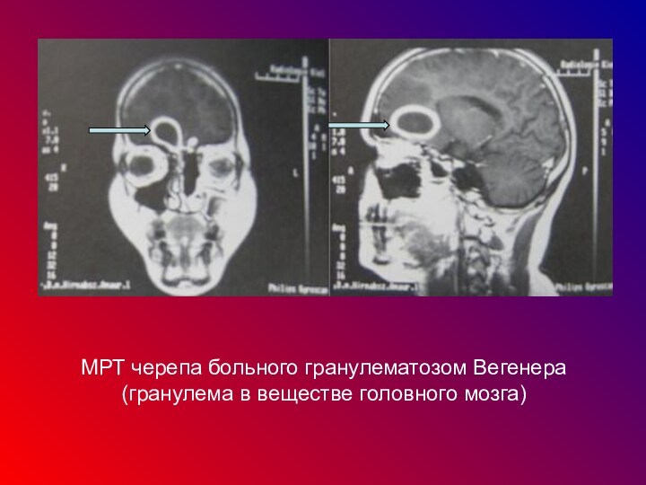 МРТ черепа больного гранулематозом Вегенера (гранулема в веществе головного мозга)