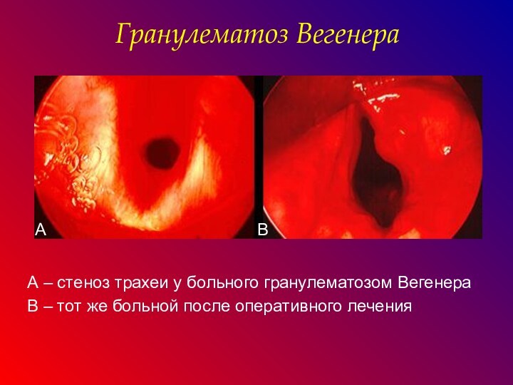 А – стеноз трахеи у больного гранулематозом ВегенераВ – тот же больной после оперативного леченияГранулематоз ВегенераАВ