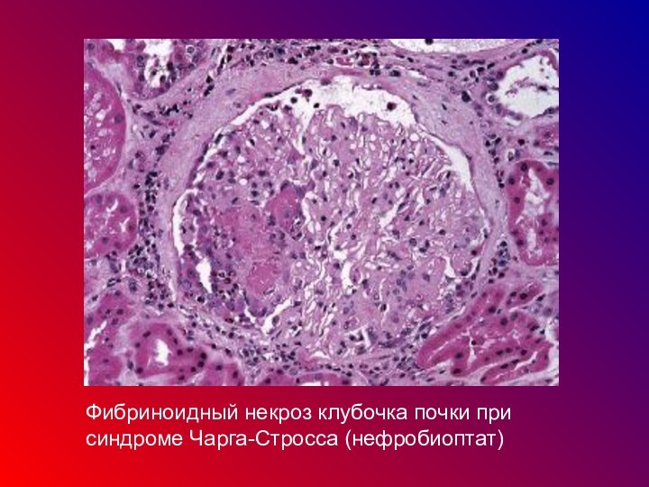 Фибриноидный некроз клубочка почки при синдроме Чарга-Стросса (нефробиоптат)