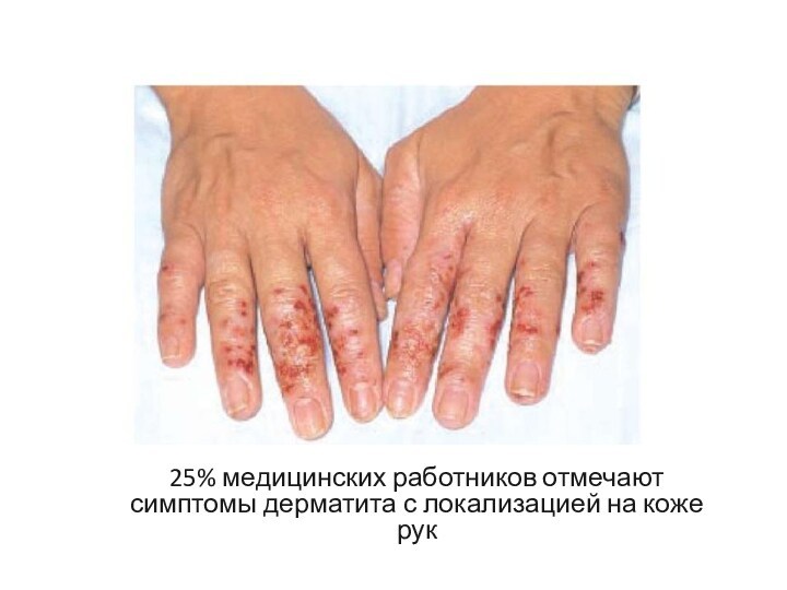 25% медицинских работников отмечают симптомы дерматита с локализацией на коже рук