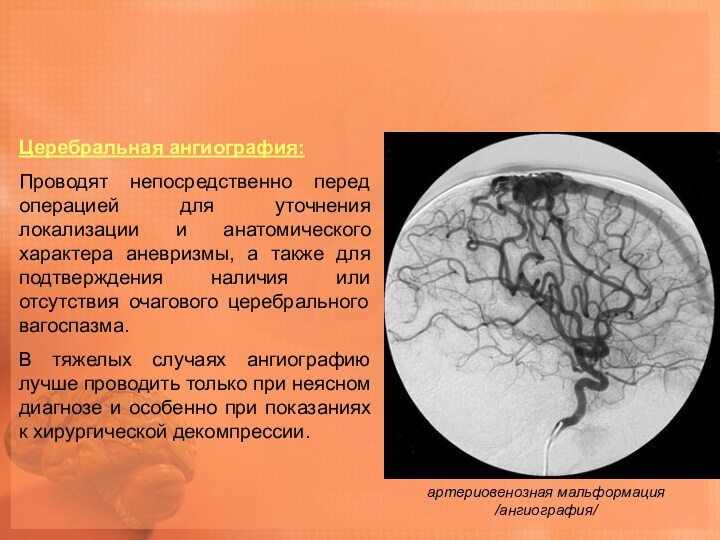 Диагностика  геморрагического инсультаЦеребральная ангиография:Проводят непосредственно перед операцией для уточнения локализации и анатомического характера аневризмы,