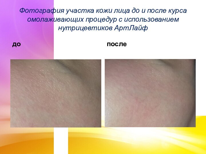 допослеФотография участка кожи лица до и после курса омолаживающих процедур с использованием нутрицевтиков АртЛайф