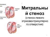 Митральный стеноз (стеноз левого атриовентрикулярного отверстия)