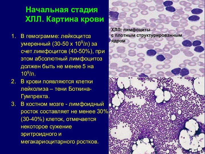 Хронический лимфолейкоз презентация