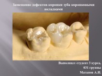 Замещение дефектов коронки зуба коронковыми вкладками