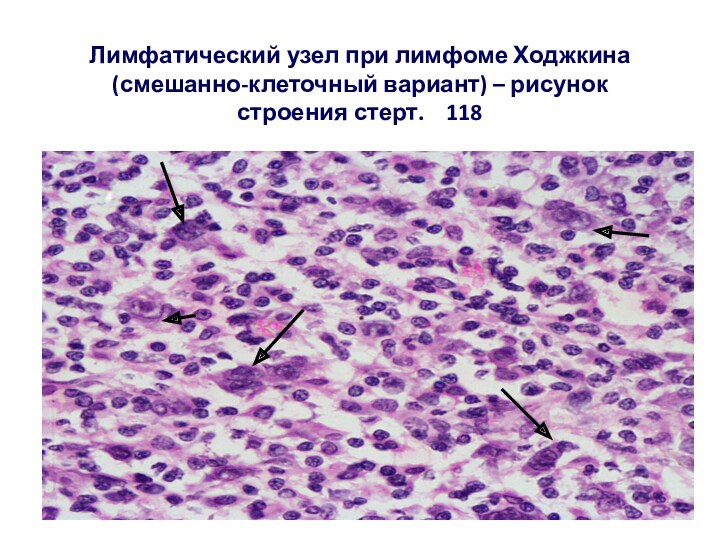 Лимфатический узел при лимфоме Ходжкина (смешанно-клеточный вариант) – рисунок строения стерт.  118