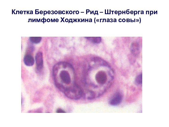 Клетка Березовского – Рид – Штернберга при лимфоме Ходжкина («глаза совы»)