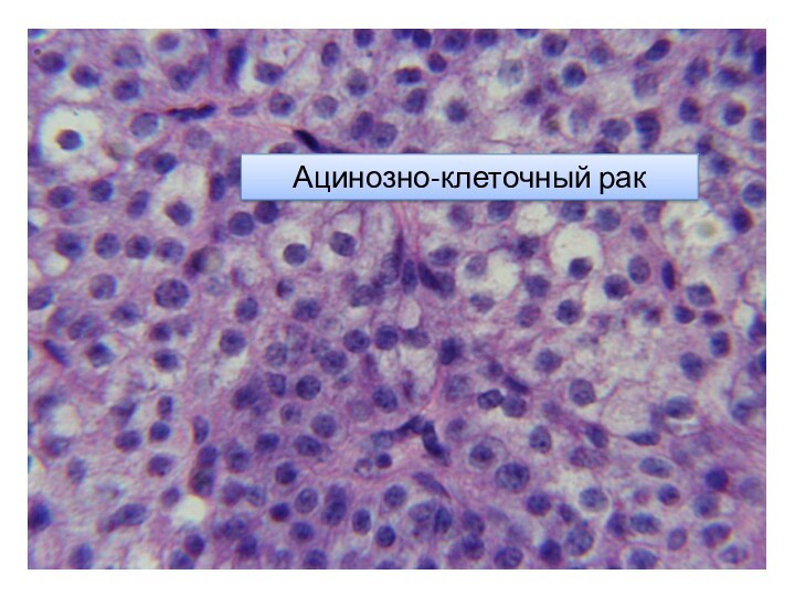 Ацинозно-клеточный рак